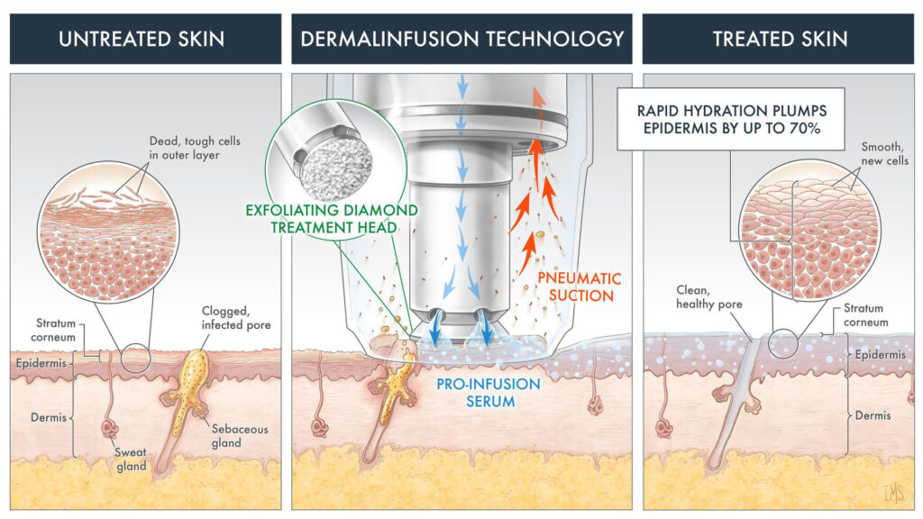 Dermal Infusion